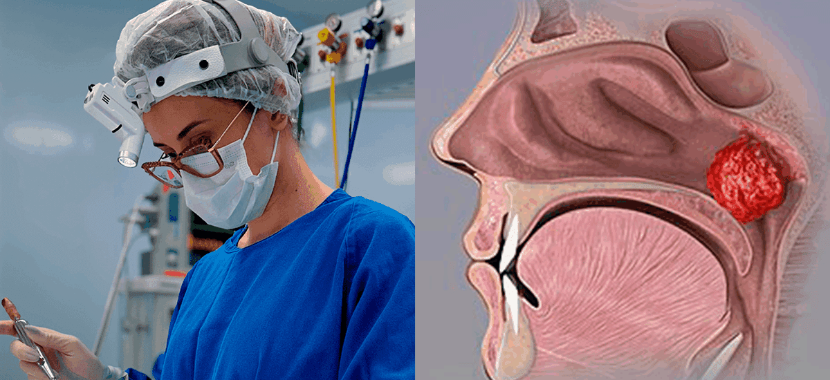 Otorrino em Brusque, cirurgia de adenoide em crianças, quando é necessária - dra mariana nunes