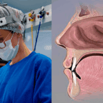 Otorrino em Brusque, cirurgia de adenoide em crianças, quando é necessária - dra mariana nunes