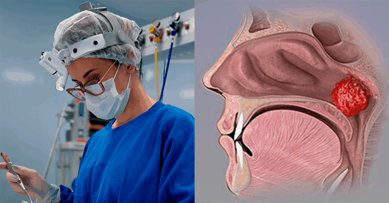 Cirurgia de Adenoide em Crianças: quando é indicada e como funciona